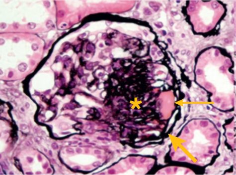 Stage 3 histopathologic image in IgA nephropathy