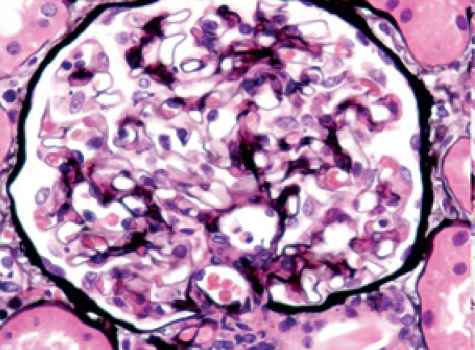 Stage 1 histopathologic image in IgA nephropathy