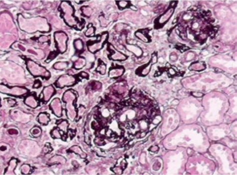 Stage 4 histopathologic image in IgA nephropathy