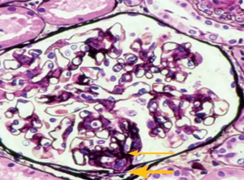 Stage 2 histopathologic image in IgA nephropathy